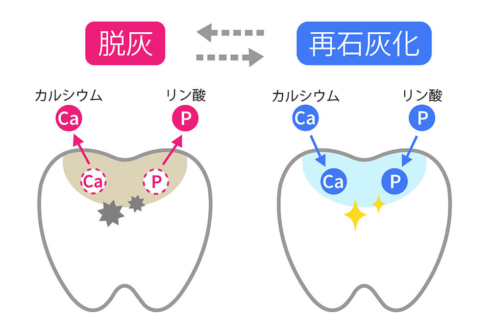 むし歯の基礎知識