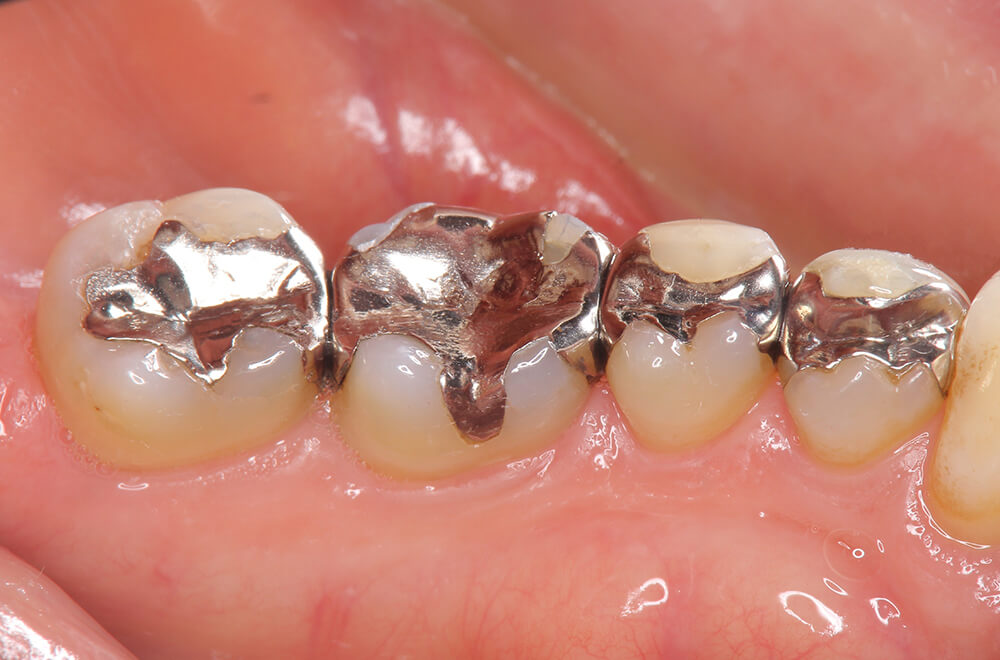 銀歯が身体の不調の原因になることも……！？