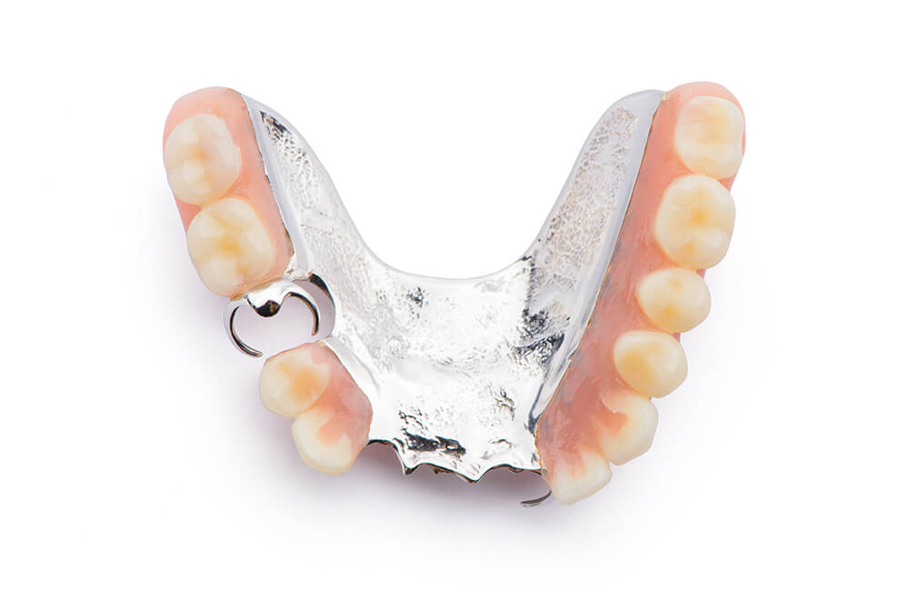 金属床義歯（チタン・コバルトクロム）