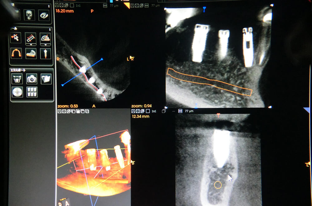 インプラント治療においての歯科用CTの必要性