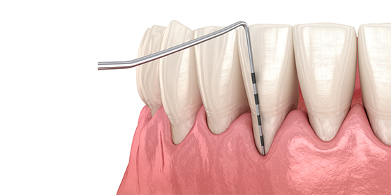 歯周病治療