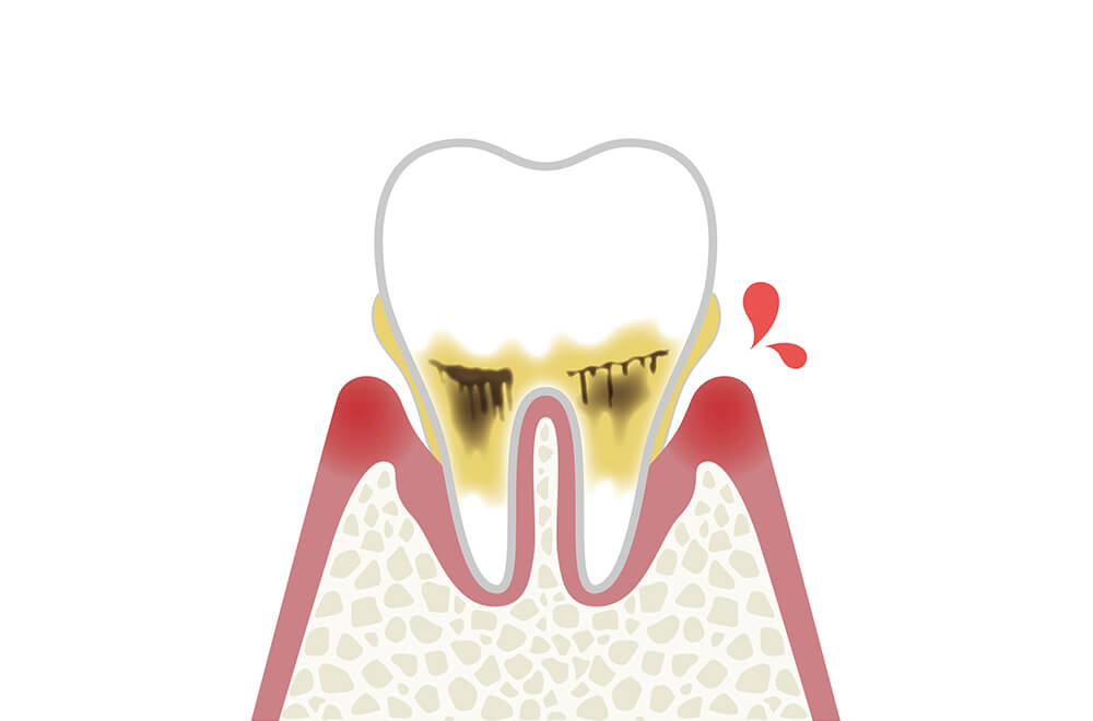 軽度歯周炎